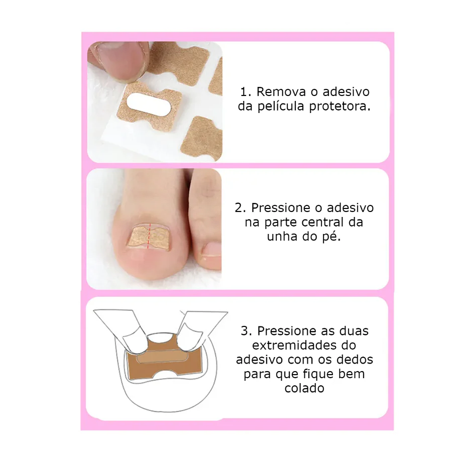 Adesivo para Unhas Encravadas - Pack 30 - Image 6
