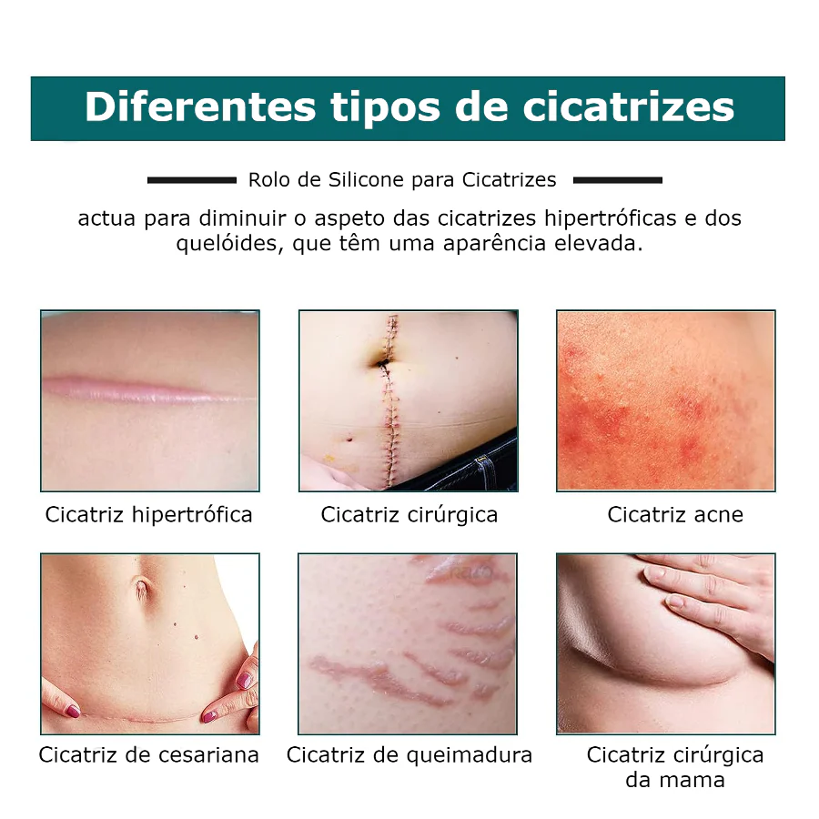 Rolo de Silicone para Cicatrizes - Image 3